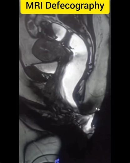 38K views · 182 reactions | #anatomy #MRI #lesiones #defecography | CT Scan and MRI study | Facebook