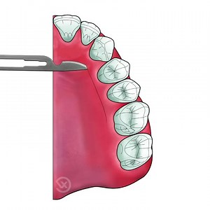 2.7K views · 81 reactions | How to harvest connective tissue graft. Credit @dr_francois_vigouroux #Dentistry #LearningTips | Bites & Braces Dental | Facebook