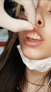 2.7M views · 7.1K reactions | Smiley Piercing Performed By A Professional #smileypiercing #smileypiercings #piercing #piercingeducation #piercingcare #piercings | piercing.world | Facebook