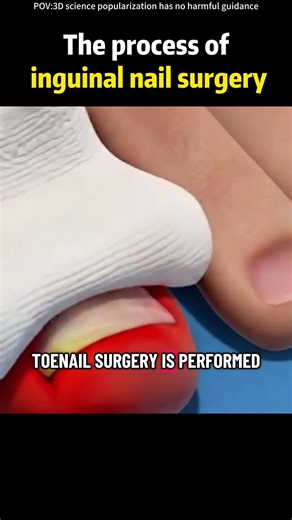 How Ingrown Toenail Removal Surgery Is Performed? (3D Animation)#ingrowntoenail #ingrowntoenailremoval #ingrowntoenailsurgery #ingrowntoenailtreatment #ingrowntoenailremoved