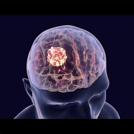 Know the Signs of a Brain Tumor: This video explores the 9 warning signs of a brain tumor. Early detection is crucial, so watch and share! #brain #tumor #cancer #meningitis #braintumor #goviral #benign #health #malignant #creatorsearchinsights @Mizz Brown♥️ @Kumarie Persaud 🇨🇦 🍁🇬🇾 @GodsLoveOHEMAAPHINA39 @Leticia @Esther @Adwumawura Kwabena @PS. Dr E.K. BERKO @TT