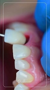 Single Tooth Implant in Dubai | Dr. AL Dental Clinic City Walk, Dubai
