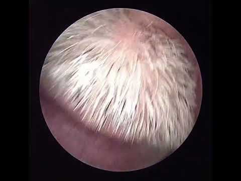 INSANE Sinus Endoscopy Cleaning 😳 | Most Satisfying Booger Removal EVER