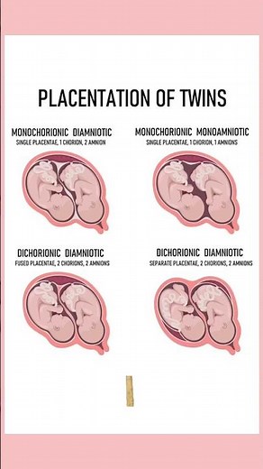 4 Types of twins medically. Twin pregnancies. #pregnant #youtubeshorts #twins September 4, 2024