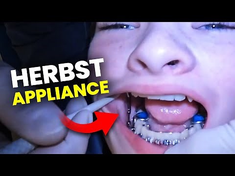 Patient Getting a Herbst Appliance… full walkthrough | Orthodontist explains