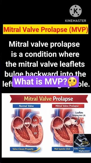 What is Mitral Valve Prolapse (MVP)# basic and simple explanations Echocardiogram # ytshorts