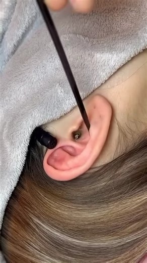 It looked small, but wait till you see the ending! #drpimplepopper #grossaddiction 6 | Pimple Popping videos 9