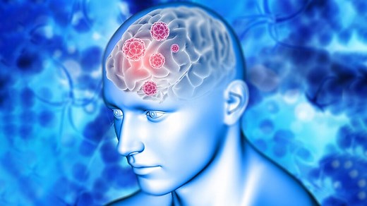 Understanding Brain Blood Clot Symptoms: Expert Shares the Signs and Tips to Seek Prompt Treatment