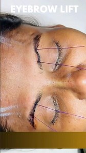 Eyebrow Thread Lift: Instant Lift & Youthful Look by Dr. Adarsh Tripathi #eyebrows #beauty