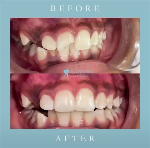 Another smile saved🥹 Composite restoration for our 10 year old patient who accidentally broke her tooth while playing 🦷 #braces #dentistry #teeth #oralhealth #compositerestoration #trendingvideo #fypシ゚ #fyppage #fypviral