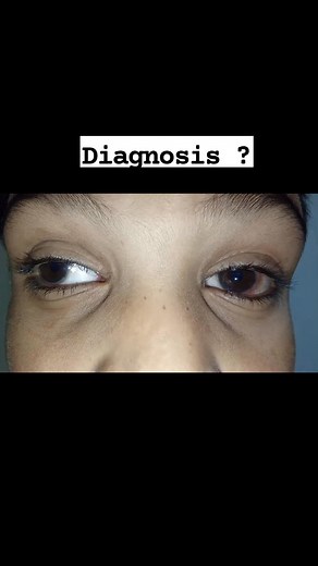 Comment your Diagnosis and Observations | Optometry and Ophthalmology Videos. #clinicaloptometry #eyecare #MedicalEducation #eye #docter #ophthalmology #postviralシ #fbviralpost2025シ #glasses #retina | Vision Scientist