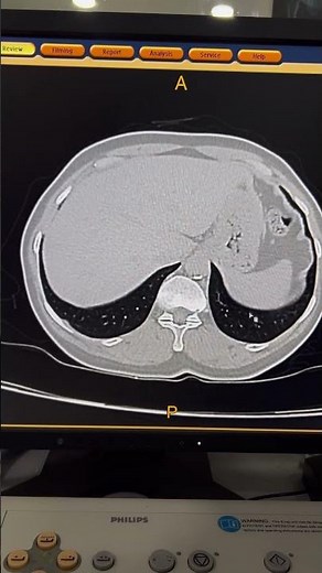 HRCT Pneumonia vs GGO Pattern | Chest CT #shorts