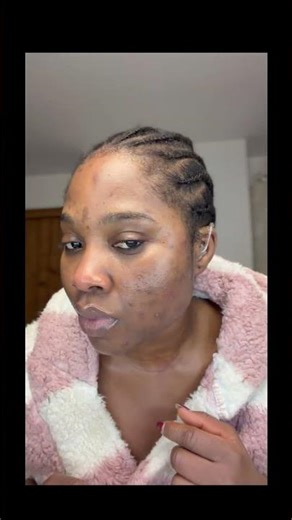 Hormonal Acne Flare-Ups? You Might Be Doing This #skincaretips