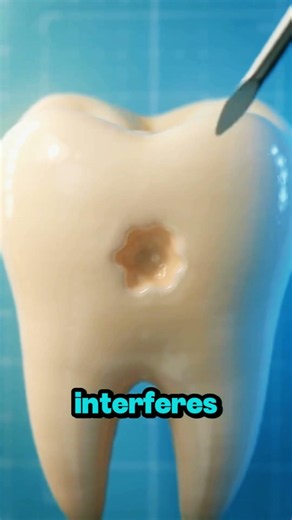 The satisfying way to fill a cavity 🦷 #dentist #teeth #dental