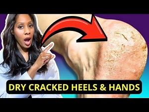 The BEST TREATMENTS FOR DRY, CRACKED HEELS & DRY HANDS! A Doctor Explains