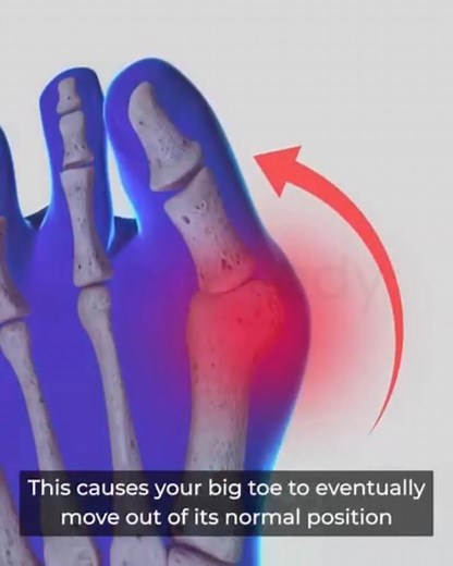 Here is an easy, at home fix for bunion discomfort and foot pain. If you’ve been noticing discomfort around your big toe, tightness when you walk, or that “out of alignment” feeling after a long day… you’re not imagining it. Foot stress adds up — especially if you’re on your feet often, wear narrow shoes, or simply experience natural changes over time. And the truth is, when your feet don’t feel supported, everything becomes harder: standing for long periods, running errands, finishing your work