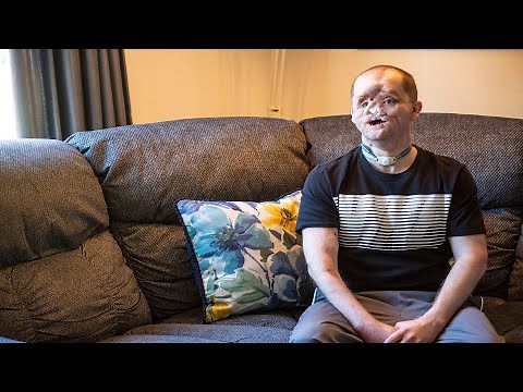 Michigan man seeking face transplant shares his story
