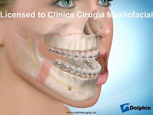 Maxillary Advancement with Mandibular Setback
