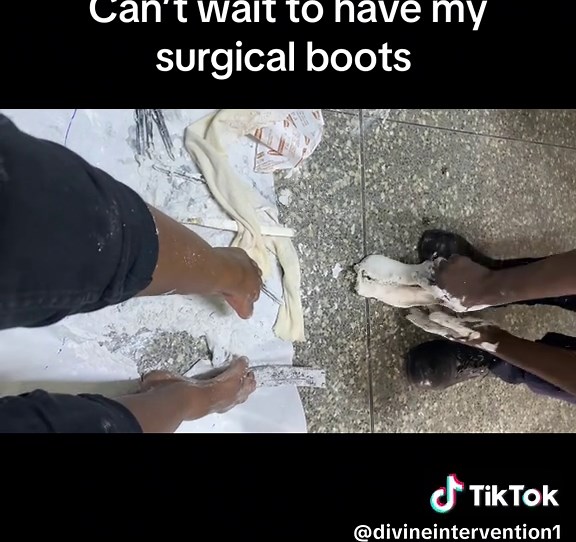 Understanding Clubfoot: Symptoms and Treatment Options