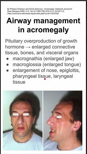 Airway management in acromegaly
