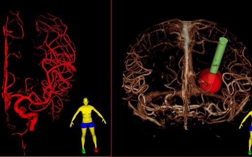 用3DSlicer创建颅内肿瘤及动静脉三维模型（3Dslicer中国社区网络公开课03）