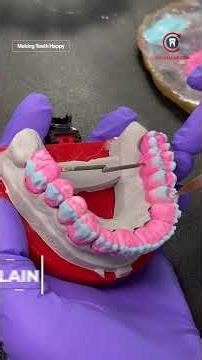 🦷 PFM Bridge with Gingival Integration - Upper Arch 🦷