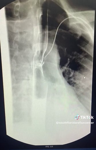 South Florida Reflux Center on TikTok