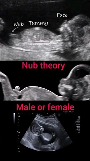 Nub theory||male or female||pregnancy #ultrasound#baby#shorts