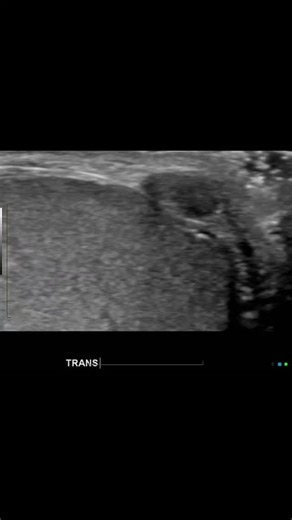 Radiology @all abnormalities 🥏🥏 on Instagram: "ULTRASOUND – SCROTUM / RIGHT TESTIS Clinical Presentation Multiple right-sided testicular/paratesticular nodules of recent onset. Non-tender. Patient Details Age: 25 years Gender: Male Ultrasound Findings Right Testis Multiple small, solid nodules are seen arising from the tunica or paratesticular tissue. Lesions are well-defined, hypoechoic to isoechoic, with no internal vascularity on color Doppler. Underlying testicular parenchyma is normal in 