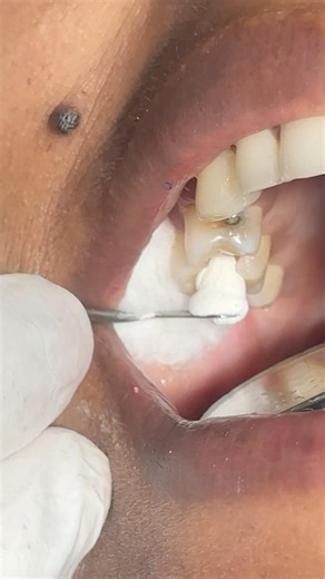 Temporary filling #dentist #dental