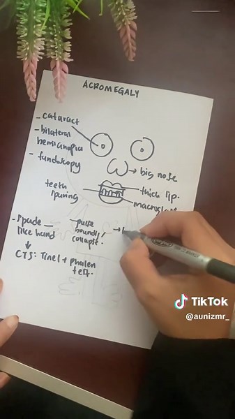 Revising Acromegaly: Tips for Exam Success!