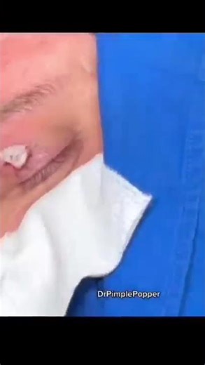 Uh-Uh-Ahhh #shorts #drpimplepopper