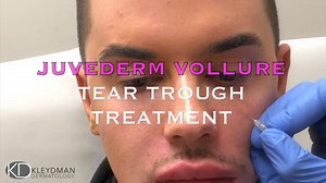 Juvederm Vollure Tear Trough Rejuvenation