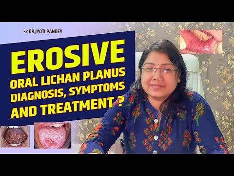 Erosive oral Lichan planus diagnosis, symptoms and treatment.