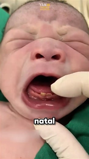 Why are some babies born with teeth⁉️😳 #baby #newborn #medical