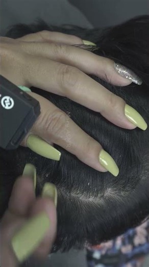 Quick and Easy Removing Scratching Big Dandruff Flakes