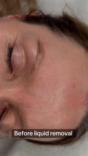 Permanent Makeup Removal in London 🇬🇧 When laser is not effective or previous removal methods have damaged the skin, liquid remover is the solution ✨ This technique is ideal for removing pigment residue after laser treatments, stubborn colors and old PMU results that won’t fade. Every case is different — that’s why I always choose the safest and most effective method individually 🤍 If you think it can’t be removed — it can. 📍 London #permanentmakeupremoval #pmuremovallondon #pmuremover #liqu