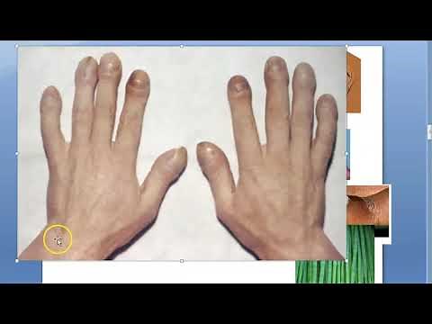 Medicine 0581 Clubbing WHy cause Types Differential fingers hand one Unilateral Unidigital