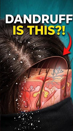The Microscopic Reason Dandruff Spreads #psychology #science