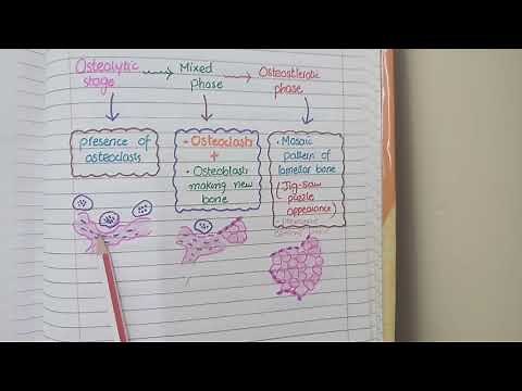 Paget's Disease Of Bone - Pathology