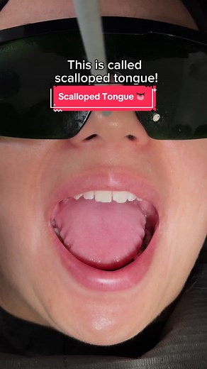 Scalloped tongue 👅 is a key indicator that our patient suffers from sleep apnea , anxiety, and nighttime teeth grinding. #tongue #scallopedtongue #oralhealth #oralcare #oralhealtheducation #teethtok