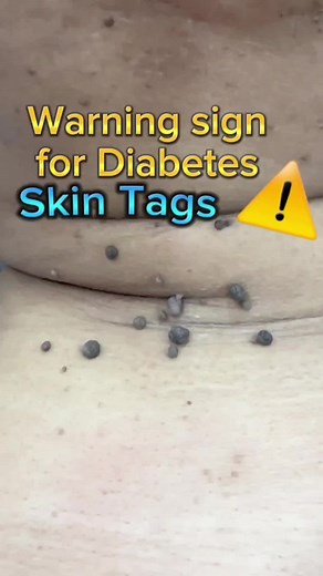 Understanding the Link Between Skin Tags and Diabetes