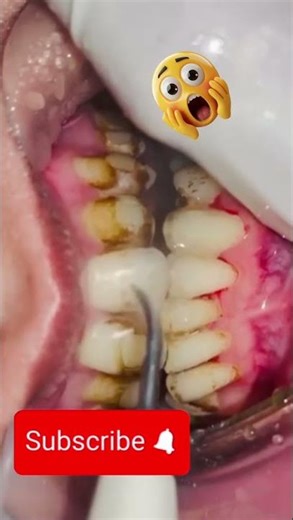 Dental Scaling #dentist #dental