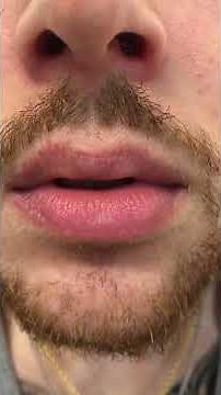 Flexitol Lip Balm & La Roche Posay Cicaplast Levres - Exfoliative Cheilitis, Dry, Peeling Lips