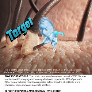 The inflammation caused by Demodex mites can complicate overall eyelid health in your patients. Learn more about XDEMVY, the only FDA-approved treatment for Demodex blepharitis. | XDEMVY (lotilaner ophthalmic solution) 0.25%