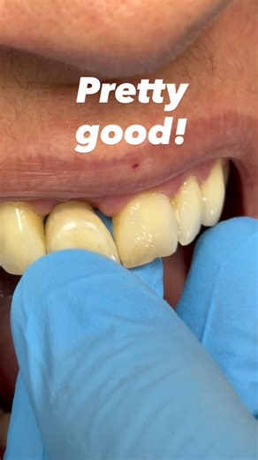 Luke Kahng on Instagram: "Another single central implant ceramic case!"