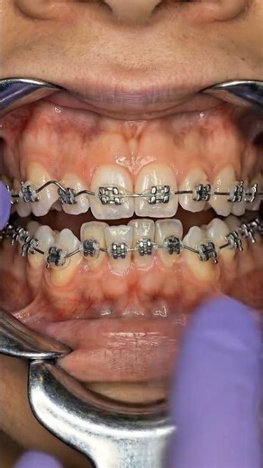 Severe Crowding Fixed 😱 | Braces Transformation Before & After