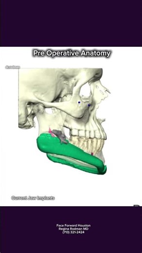 Custom Jaw Implants| Jaw Augmentation| CT Scan