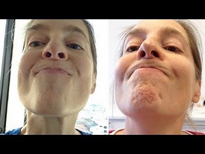 Liquidlift – Video: Erfahrungsbericht Wirkung von Botox – Vorher Nachher Vergleich (nach 7 Tagen)