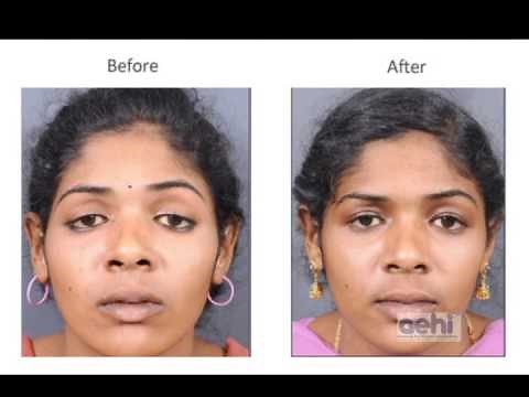 Ptosis (droopy eyelid)-Treatment and surgery (blepharoplasty) by Dr Akshay Nair, AEHI, Mumbai